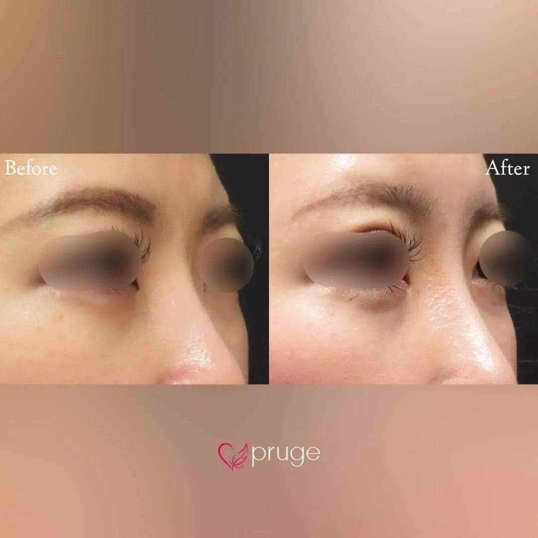 PRP注射（鼻根）