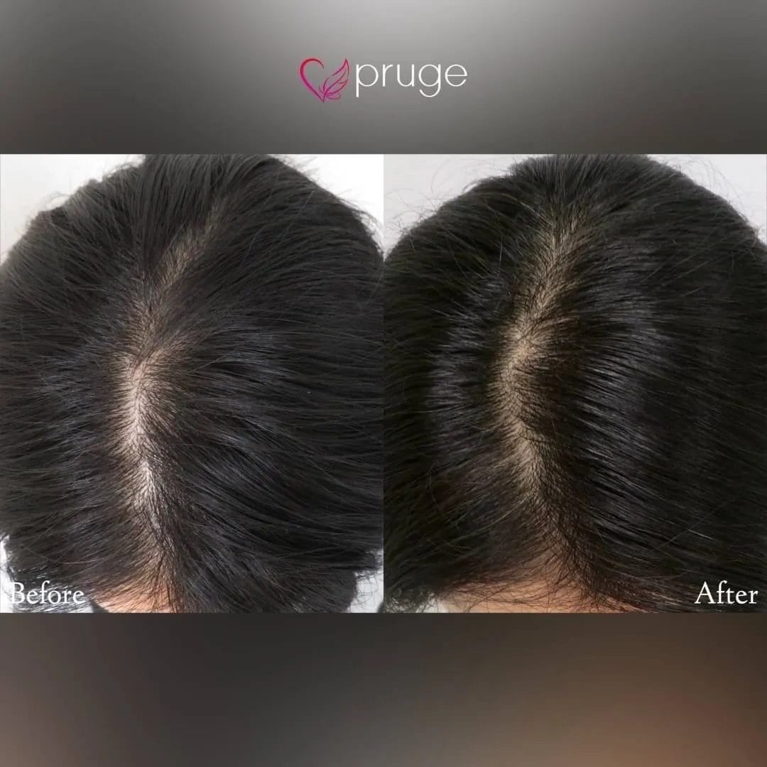 p-Scalp（2回）