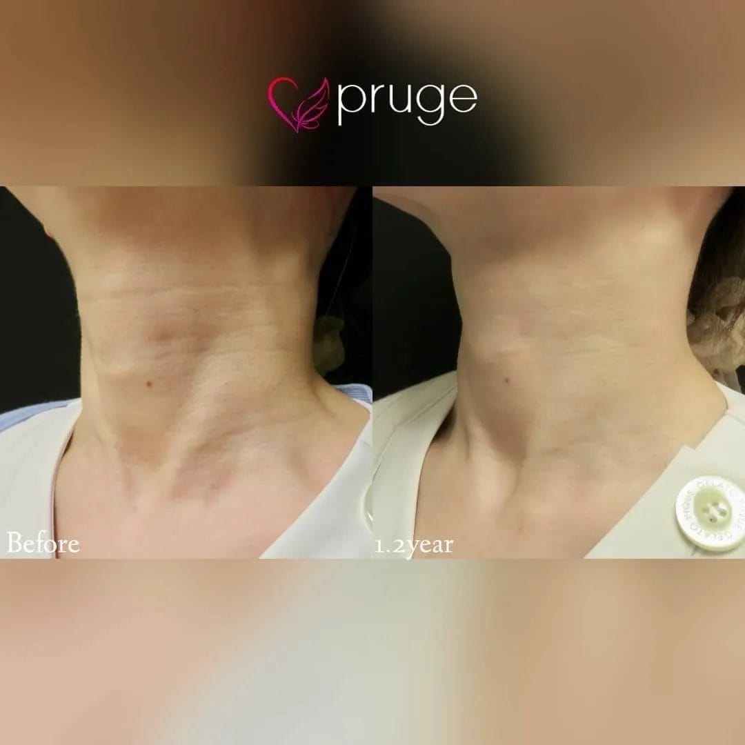 PRP注射（首）
