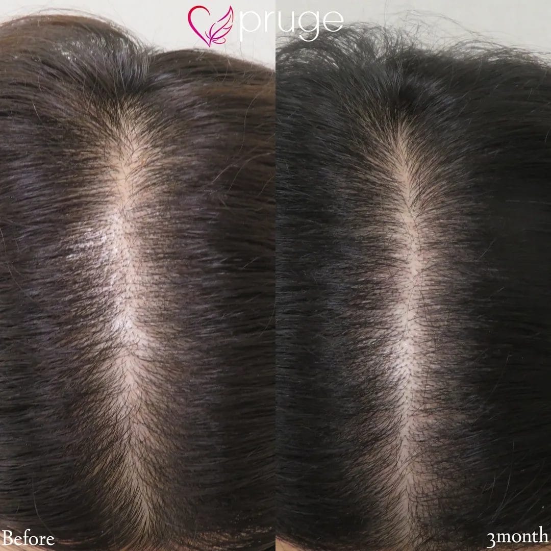 p-Scalp