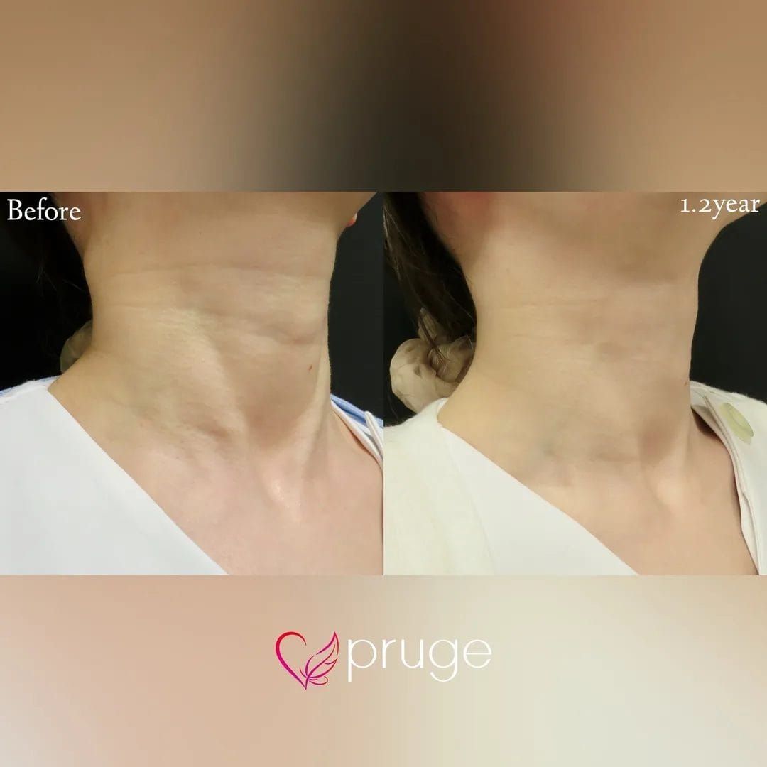 PRP注射(首)